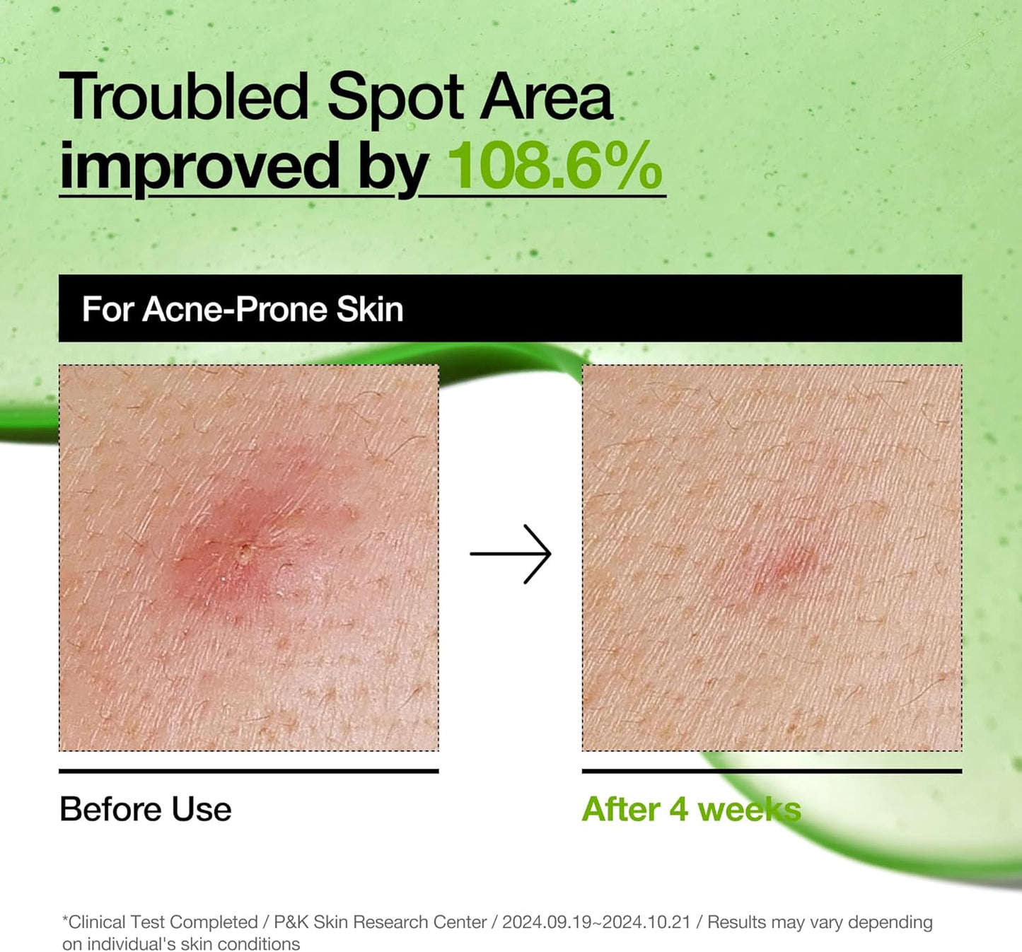 Anua Azelaic Acid 10% + Hyaluron Serum 30ml