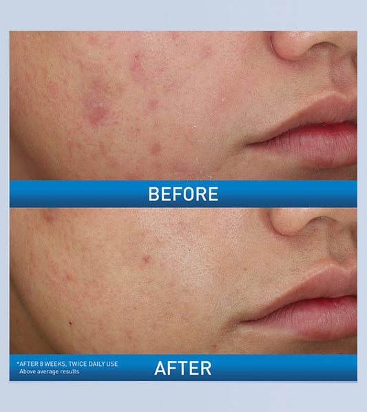 CeraVe Acne Foaming Cream Wash 10% Benzoyl Peroxide 150ml