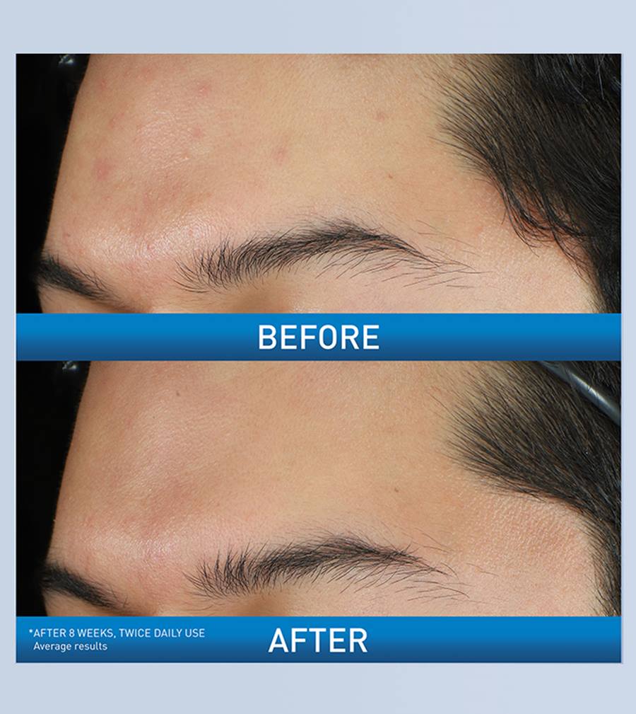 CeraVe Acne Foaming Cream Wash 10% Benzoyl Peroxide 150ml